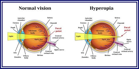 How To Tell If You Are Farsighted 5 Quick Steps Nvision Eye Centers