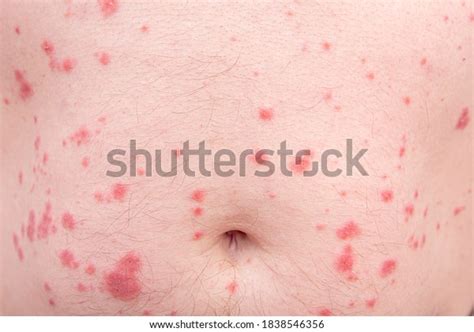 Closeup Skin Disorder Hives Allergy Human Stock Photo Edit Now 1838546356