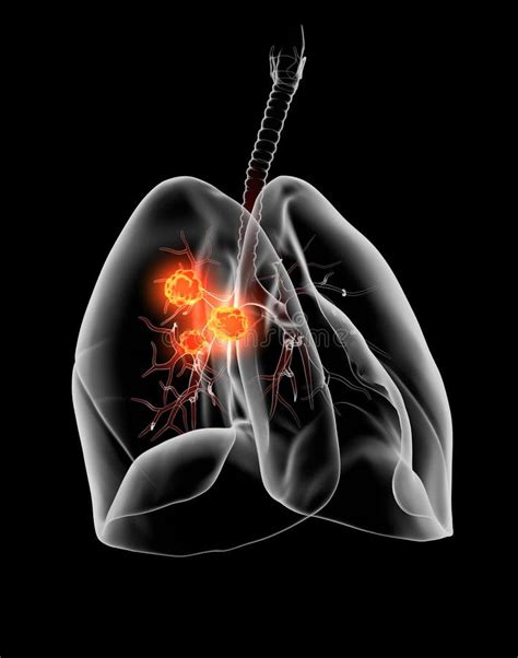 Lung Cancer Or Carcinoma Medically Illustration 3d On Black Background