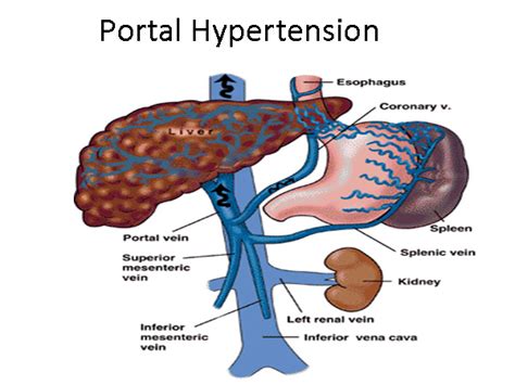 Portal Hypertension Interactive Health