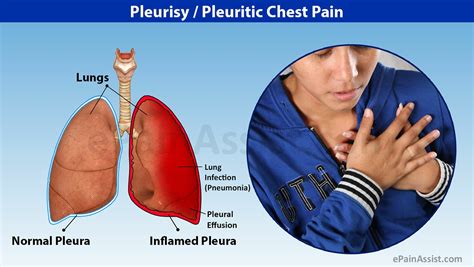 Pleurisy Symptoms Causes Diagnosis And Treatment Santripty