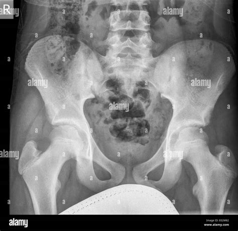 Pelvis X Ray Of 13 Year Old Male Patient Front View Stock Photo Alamy