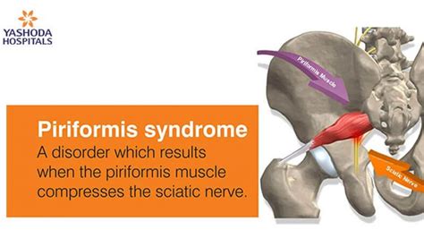 What Is Piriformis Syndrome And What Are The Treatmen
