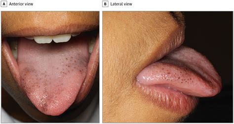 Pigmented Fungiform Papillae of the Tongue | Adolescent Medicine | JAMA ...