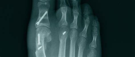 Bunion Surgery Metatarsal Osteotomy Cambridge Foot And Ankle Clinic
