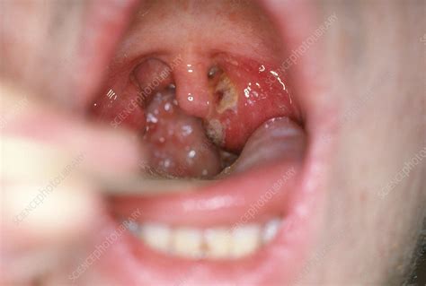 Strep Throat Stock Image C0144371 Science Photo Library
