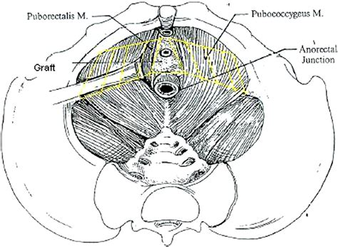 Repairing Perineal Hernia American Journal Of Obstetrics Gynecology