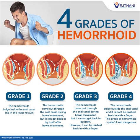 Hemorrhoids Stage