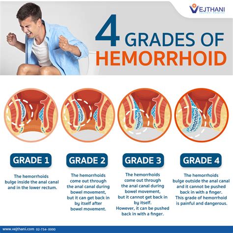 Do You Have Hemorrhoids How Severe Is Your Hemorrhoid Vejthani Hospital JCI Accredited