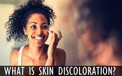 Skin Discoloration Types Causes Treatment And Much More Health
