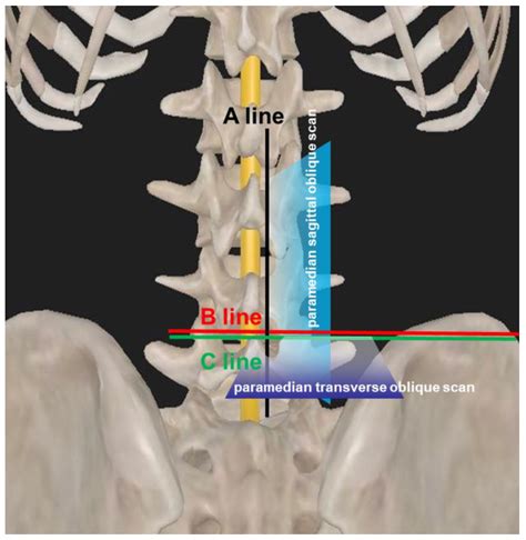 Lumbar Puncture Procedure Anatomy