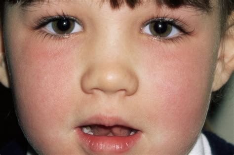 Slapped Cheek Syndrome Signs Symptoms And Treatments Of