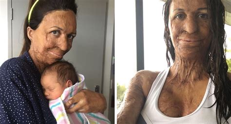 Turia Pitt Shares Her Struggle With Breastfeeding New Idea Magazine