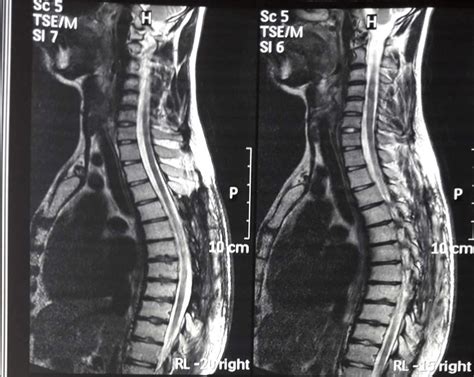Figure From Vertebral Synovial Sarcoma Onset With S Vrogue Co