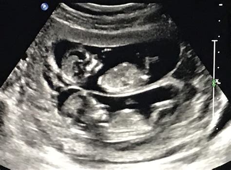 See full list on verywellhealth.com 12 Weeks Pregnant with Twins: Tips, Advice & How to Prep ...