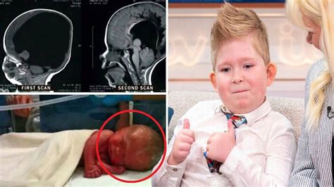 This Child Was Born Without A Brain But What Happened After 3 Years Was