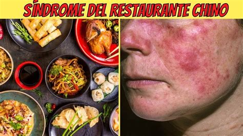 🆘 SÍndrome Del Restaurante Chino 🆘 O IntoxicaciÓn Por Gms Glutamato