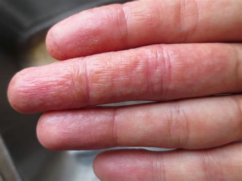 Skin Disease Types Vesicular Hand Dermatitis Skin Disease Type