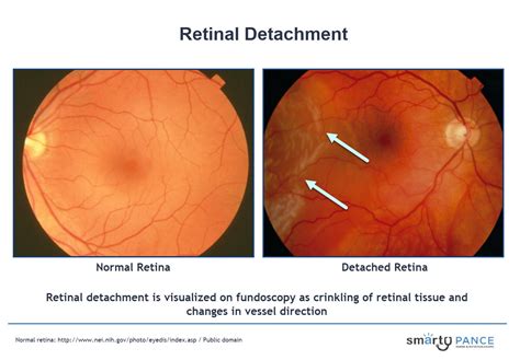 Retinal Detachment Fundoscopy