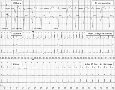 Electrocardiograms At Presentation And During Follow Up The