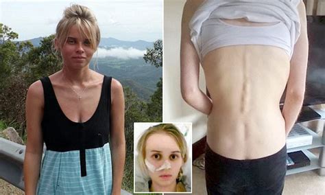 Anorexic Fears Food So Much She Believes Calories Can Be Inhaled Daily Mail Online