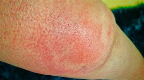 Cellulitis 6 Fast Facts That You Should Know