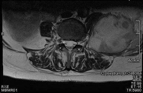 Figure 1 From Psoas Abscess Caused By Escherichia Coli Pyelonephritis