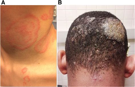 Case Report Extensive Tinea Corporis And Inflammatory Tinea Capitis