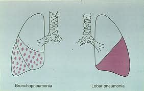 Bronchopneumonia (with lobular topography) and lobar pneumonia (lobar topography). Difference Between Lobar Pneumonia and Bronchopneumonia ...