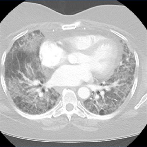 Ct Scan Of The Chest Shows Diffuse Bilateral Ground Glass Opacities