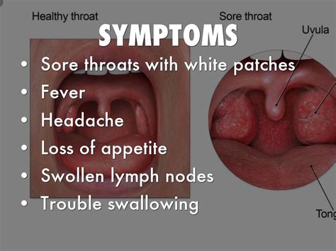 Sore Throat With White Patches On Tonsils Swollen Lymph Causes Sore