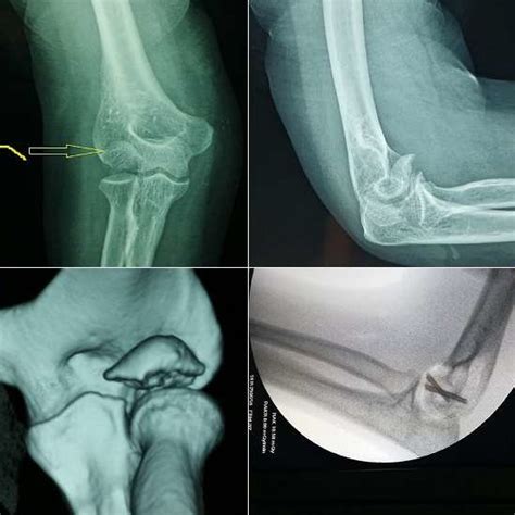 Radiographs Of The Right Elbow Anterior Posterior A And Lateral B