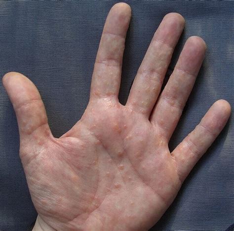 Small Itchy Bumps On Hands And Feet Causes Treatments And Home