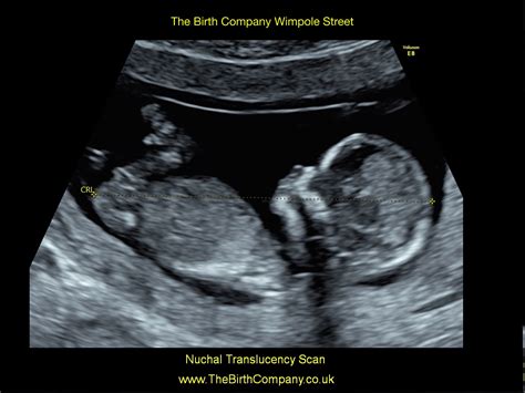 12 Week Ultrasound Down Syndrome