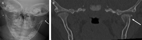 Accidental And Abusive Mandible Fractures In Infants And Tod