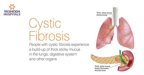 Cystic Fibrosis Lungs Mucus