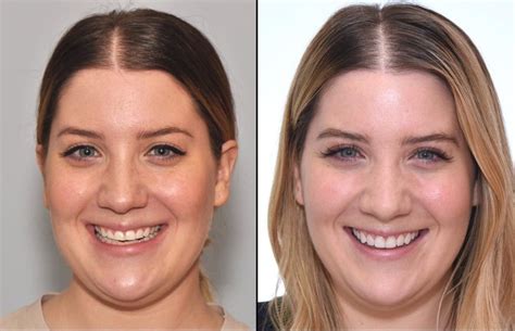 I Got Veneers And It Totally Changed My Smile Forever Teeth Makeover Celebrities With Veneers