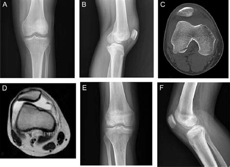 Osteochondral Injury Medial Femoral Condyle