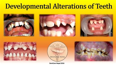 Developmental Defects Of Teeth