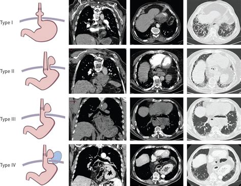 Hiatal Hernia On Thoracic Computed Tomography In Pulmonary Fibrosis