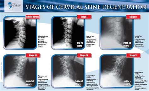 Stages Of Cervical Spine Degeneration Subluxation Cervical