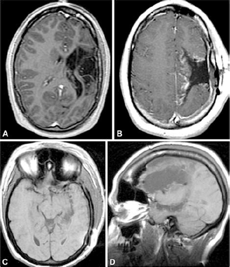 Outcomes After Hemispherectomy In Adult Patients With Intractable