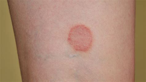 Ringworm Symptoms Causes Treatment More Goodrx