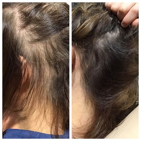 Laser Treatment For Hair Loss Chicago Hair Loss