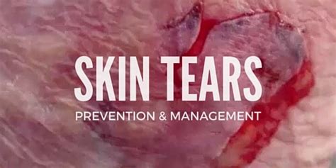 To treat a draining wound, first, wash your hands with soap and running water, and then pull on a pair of clean gloves. Ouch! Let's Talk About Skin Tears - WCEI Blog WCEI Blog