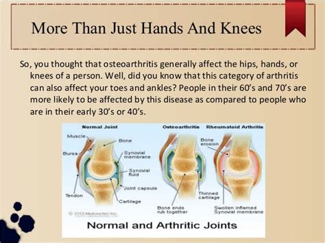 8 Surprising Facts About Arthritis Most People Dont Know