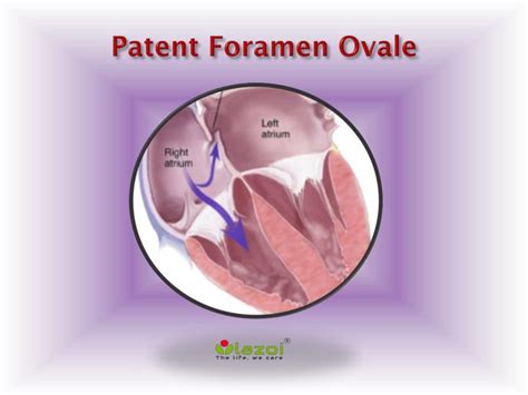 Ppt Patent Foramen Ovale Causes Symptoms Daignosis