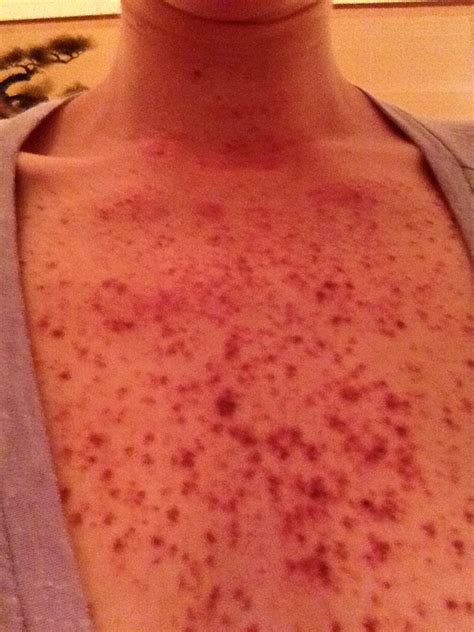 Red Liver Spots On Arms