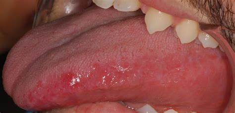 What Does A Mouth Ulcer Look Like On Tongue Infoupdate Org