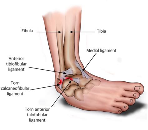 Acute Ankle Injuries Duncraig Physiotherapy
